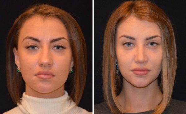 Victoria Bernikova trước và sau khi phẫu thuật thẩm mỹ. Tùy chọn hình dạng