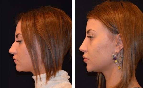 Victoria Bernikova antes e depois da cirurgia plástica. Opções de forma