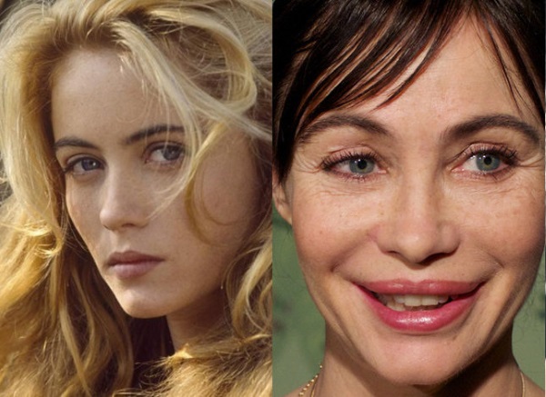 ايمانويل بير. صور قبل وبعد الجراحة التجميلية كيف تغيرت الممثلة الفرنسية