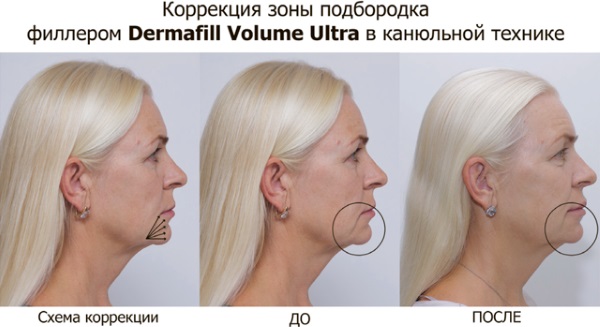 Injection facial contouring. What it is. Before and after photos, preparations, price