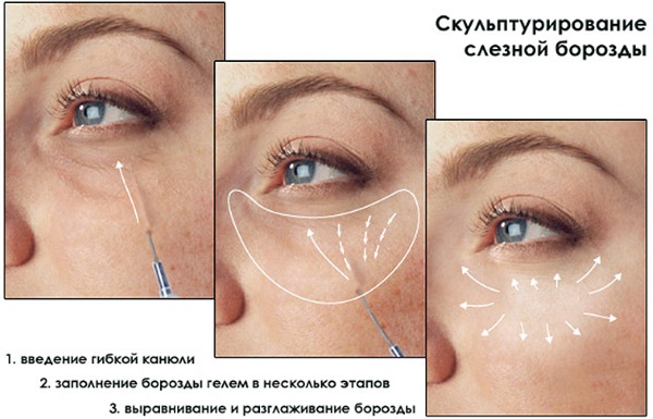 Injektion Gesichtskonturierung. Was ist das. Vor und nach Fotos, Vorbereitungen, Preis