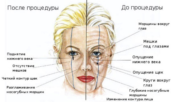 Contorno facial por inyección. Lo que es. Fotos antes y después, preparativos, precio.