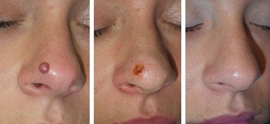Wie man Maulwürfe im Gesicht mit einer Kosmetikerin loswird, Methoden zu Hause