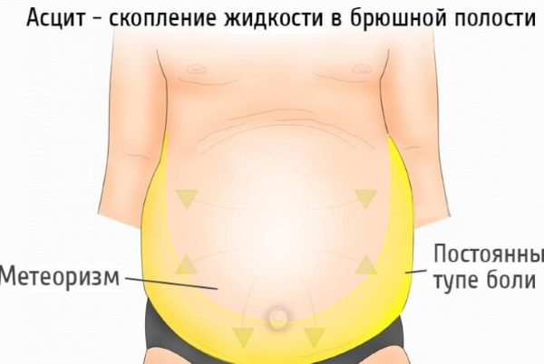 Comment enlever un gros ventre chez les femmes et les hommes. Causes et remèdes