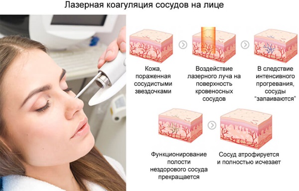 Laserverwijdering van bloedvaten in het gezicht met een neodymiumlaser, flitser, elos. voor en na foto's, recensies