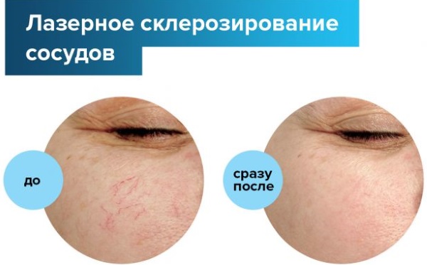 Αφαίρεση λέιζερ των αιμοφόρων αγγείων στο πρόσωπο με λέιζερ νεοδυμίου, flash, elos πριν και μετά από φωτογραφίες, κριτικές