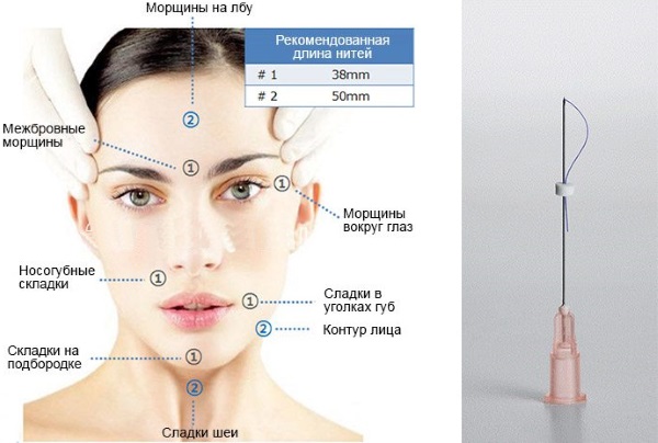 Fogaskerék szálak az arcplasztika javításához. Ár, vélemények, fotók előtt és után, rehabilitáció