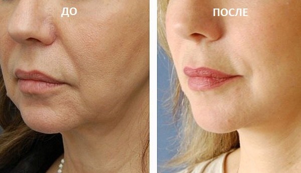 Fogaskerék szálak az arcplasztika javításához. Ár, vélemények, fotók előtt és után, rehabilitáció