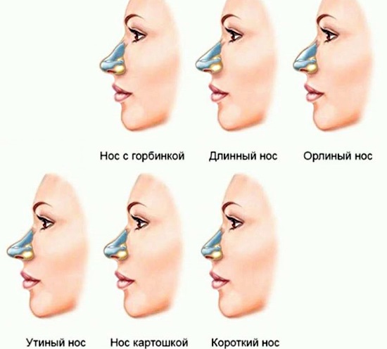 Com arreglar el nas d’una dona amb patates. Rinoplàstia, foto abans i després de la cirurgia, preu