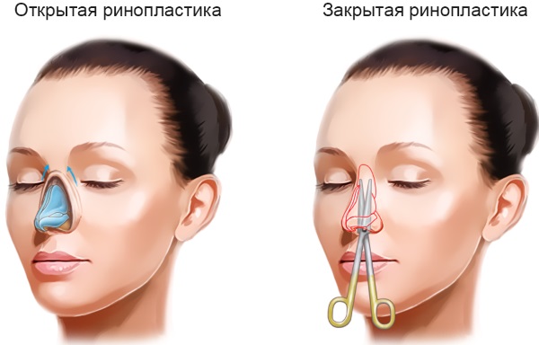 Hoe de neus van een vrouw te repareren met aardappelen. Neuscorrectie, foto voor en na de operatie, prijs