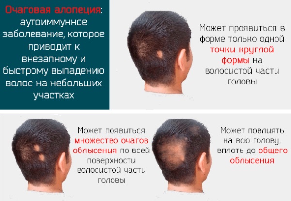 Плазмолифтинг главе за косу. Пре и после фотографија, контраиндикације, прегледи