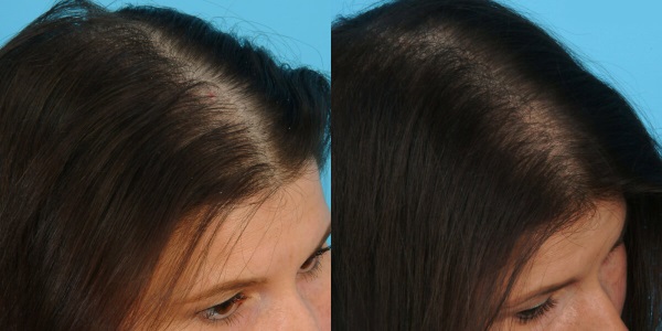 Plasmolifting του κεφαλιού για τα μαλλιά. Πριν και μετά τις φωτογραφίες, αντενδείξεις, κριτικές