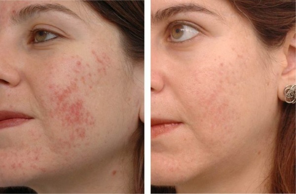 Ungüento de zinc para el rostro contra las arrugas en cosmetología. Que ayuda, como usar