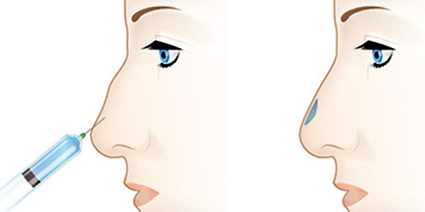 Rinoplàstia no quirúrgica de la punta del nas amb farciment, medicaments. Abans i després de les fotos, preu
