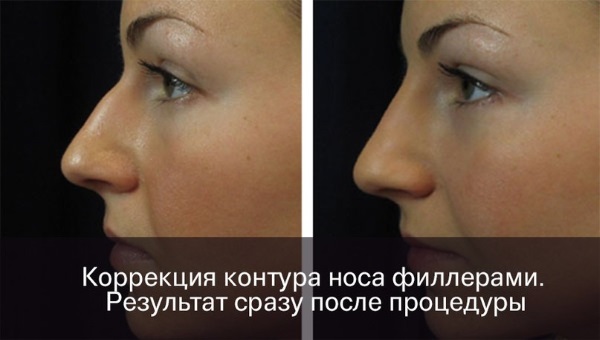 Rinoplàstia no quirúrgica de la punta del nas amb farciment, medicaments. Abans i després de les fotos, preu