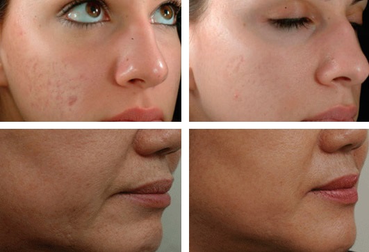 Mésothérapie fractionnelle du visage: indications, résultats, effets secondaires, conséquences. Commentaires