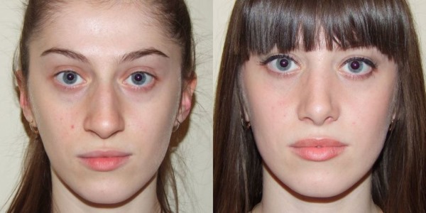 Rajeunissement du visage au plasma. Types de procédures, appareils, photos avant et après, avis