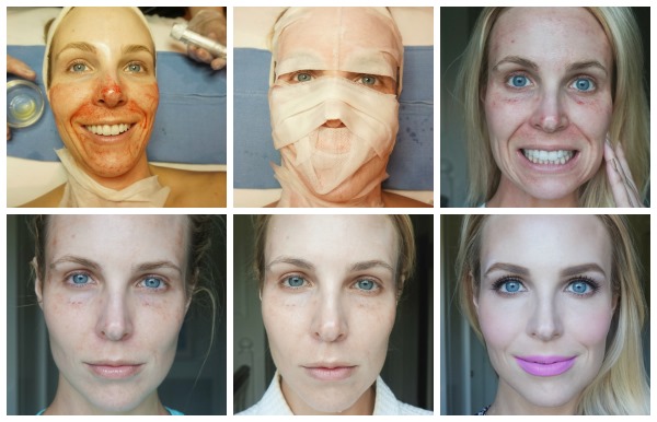 Peremajaan wajah plasma. Jenis prosedur, peranti, sebelum dan selepas foto, ulasan