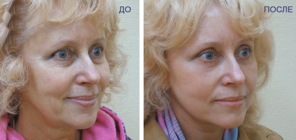 Rejuvenescimento facial de plasma. Tipos de procedimentos, dispositivos, fotos antes e depois, avaliações