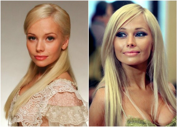 Actrices russes avant et après la chirurgie plastique du visage. Une photo