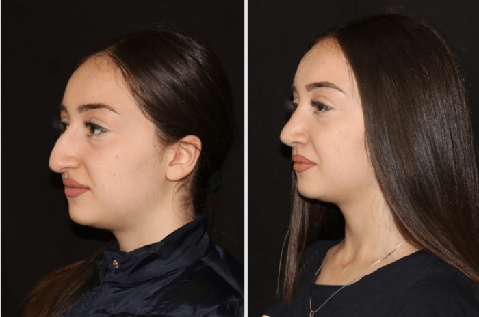 Non-surgical rhinoplasty of the nose. Photo, how it is done, how to choose a clinic, a doctor. Reviews