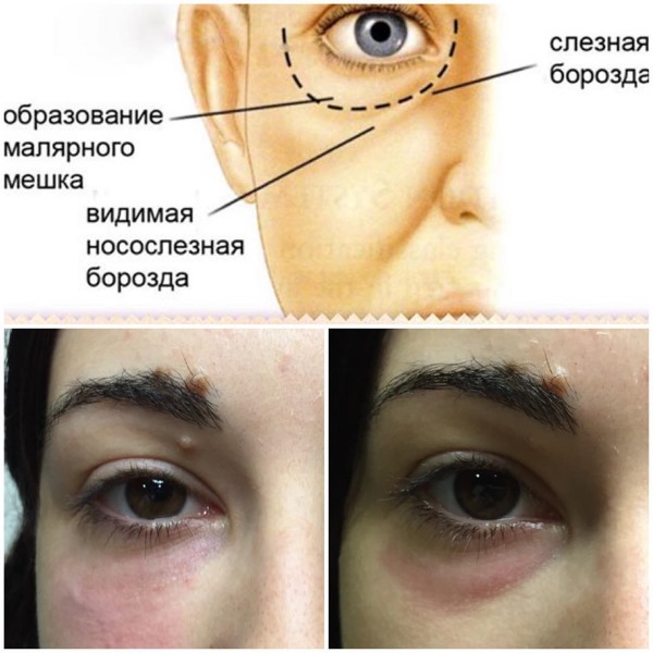 Tyndall-Effekt in der Kosmetik unter den Augen, auf der Haut der Lippen. Wenn beobachtet, wie man entfernt
