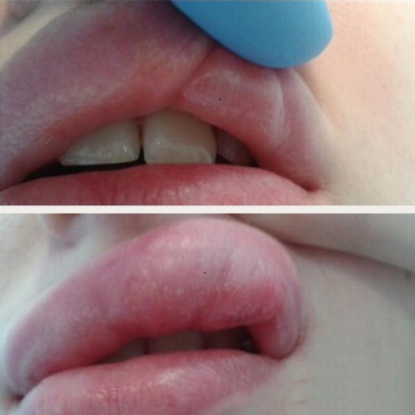 Tyndall-effect in cosmetica onder de ogen, op de huid van de lippen. Wanneer geobserveerd hoe te verwijderen