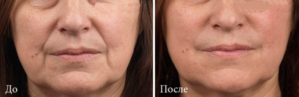 Tyndall-effect in cosmetica onder de ogen, op de huid van de lippen. Wanneer geobserveerd hoe te verwijderen