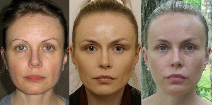 Endoscopic forehead and eyebrow lifting. Photos before and after, how it is done, consequences, reviews