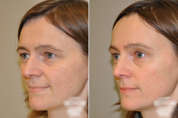 Lifting endoscopico della fronte e delle sopracciglia. Foto prima e dopo, come è fatto, conseguenze, recensioni