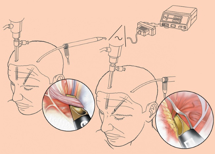 Lifting endoscopique du front et des sourcils. Photos avant et après, comment c'est fait, conséquences, critiques
