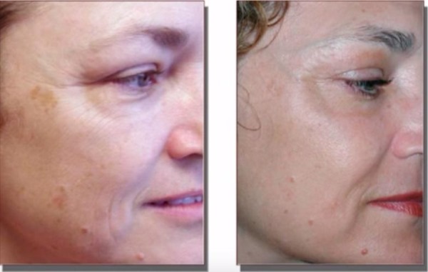 Fraxel-Lasertherapie für die Gesichtshaut. Indikationen, vor und nach Fotos, Bewertungen