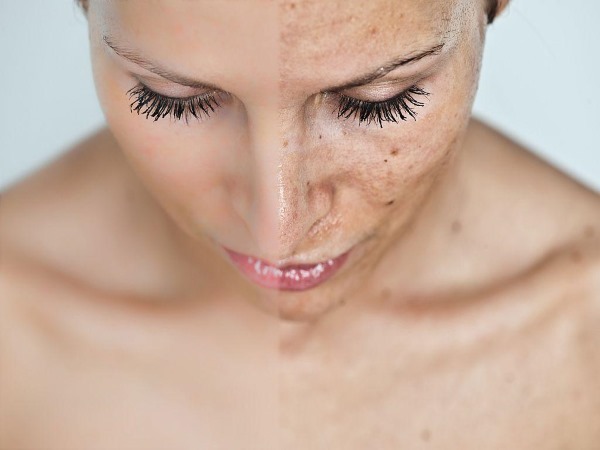 Teràpia làser Fraxel per a pells facials. Indicacions, fotos abans i després, ressenyes