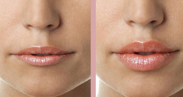 Kako usne povećati bez kirurgije pomoću šminke, bočica, vježbi kod kuće