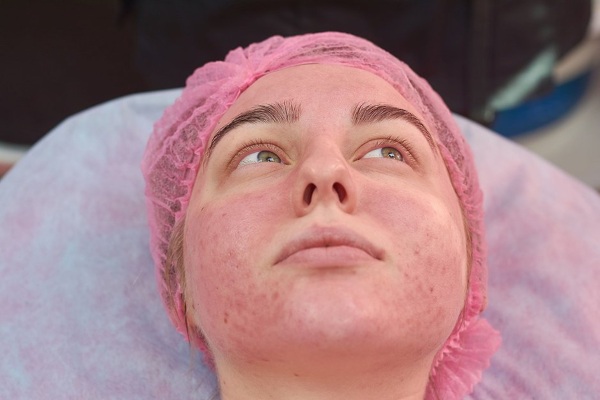 Élimination des capillaires sur le visage avec un laser. Comment se déroule la procédure, contre-indications, conséquences, prix, avis
