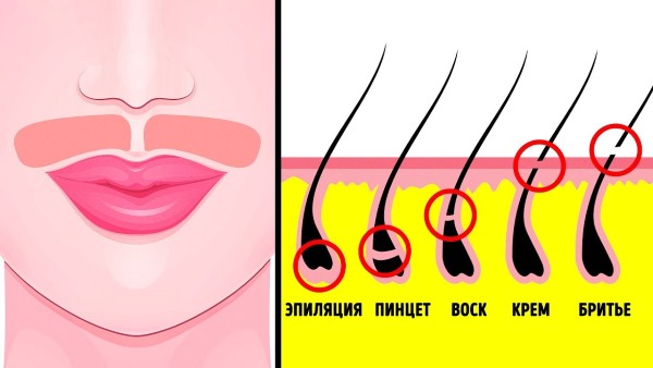 Αποτρίχωση με λέιζερ του άνω χείλους (κεραίες) στις γυναίκες. Πόσες συνεδρίες χρειάζονται, πώς γίνεται