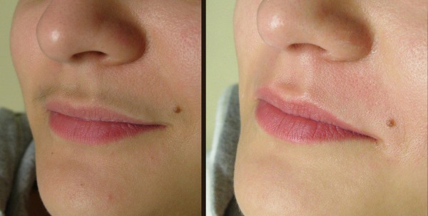 Laser hair removal of the upper lip (antennae) in women. How many sessions are needed, how is it done