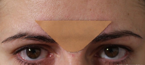 How to remove a wrinkle between eyebrows. Plaster, ointments, creams, exercises, massage, botox