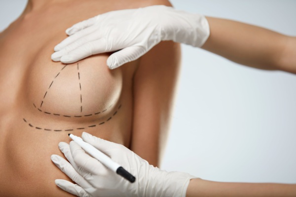 Mamoplastia para cirurgia redutora de mama. Quanto custa um facelift, tipos, como fazer de graça