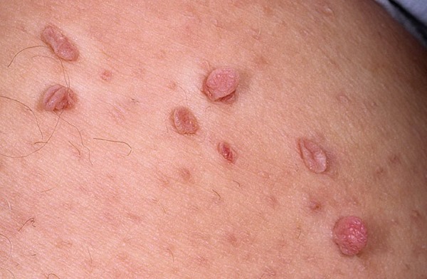 Papillomas trên cơ thể ở phụ nữ. Nguyên nhân và cách điều trị, cách khỏi bằng các bài thuốc dân gian