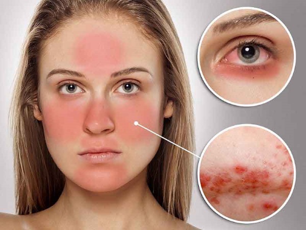 Élimination des capillaires sur le visage avec un laser. Comment se déroule la procédure, contre-indications, conséquences, prix, avis