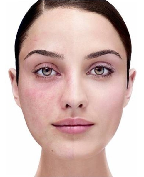 Remoção de capilares da face com laser. Como está o procedimento, contra-indicações, consequências, preço, avaliações