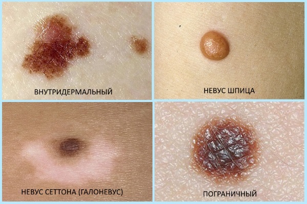 Laser removal of neoplasms on the skin, growths, papillomas. How is the procedure, price, reviews