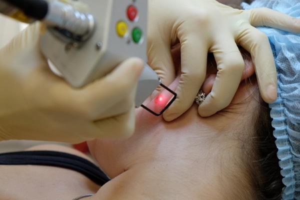 Remoção a laser de neoplasias da pele, crescimentos, papilomas. Como está indo o procedimento, preço, avaliações