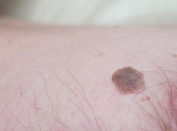 Laserverwijdering van neoplasmata op de huid, gezwellen, papillomen. Hoe is de procedure, prijs, beoordelingen