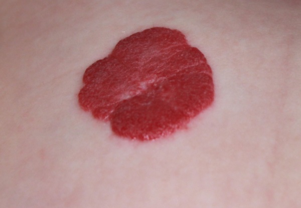 Laserverwijdering van neoplasmata op de huid, gezwellen, papillomen. Hoe is de procedure, prijs, beoordelingen