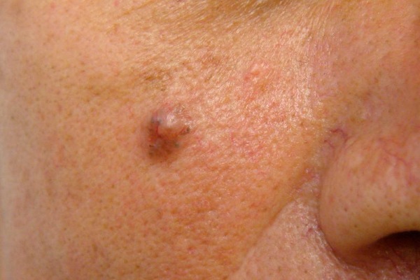 Neoplazmų pašalinimas lazeriu ant odos, ataugų, papilomų. Kaip yra procedūra, kaina, apžvalgos