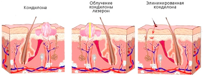 Eliminació làser de neoplàsies a la pell, creixements, papil·lomes. Com és el procediment, el preu, les ressenyes