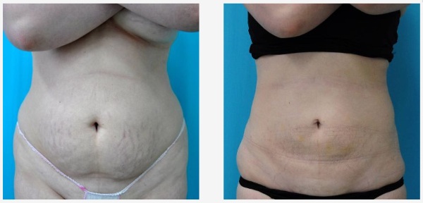 Lipoaspiração não cirúrgica do abdômen. Foto antes e depois do laser, ultrassom, comentários, preço