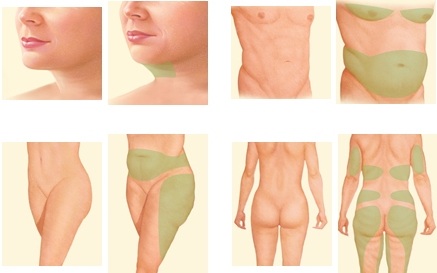 Liposuction abdomen bukan pembedahan. Foto sebelum dan selepas laser, ultrasound, ulasan, harga